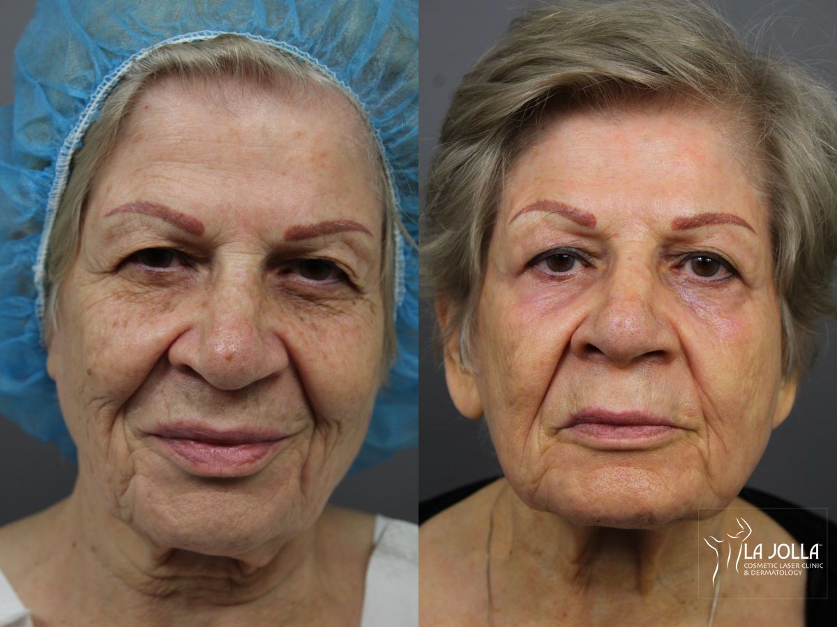 Before and after SP Dynamis case 36365