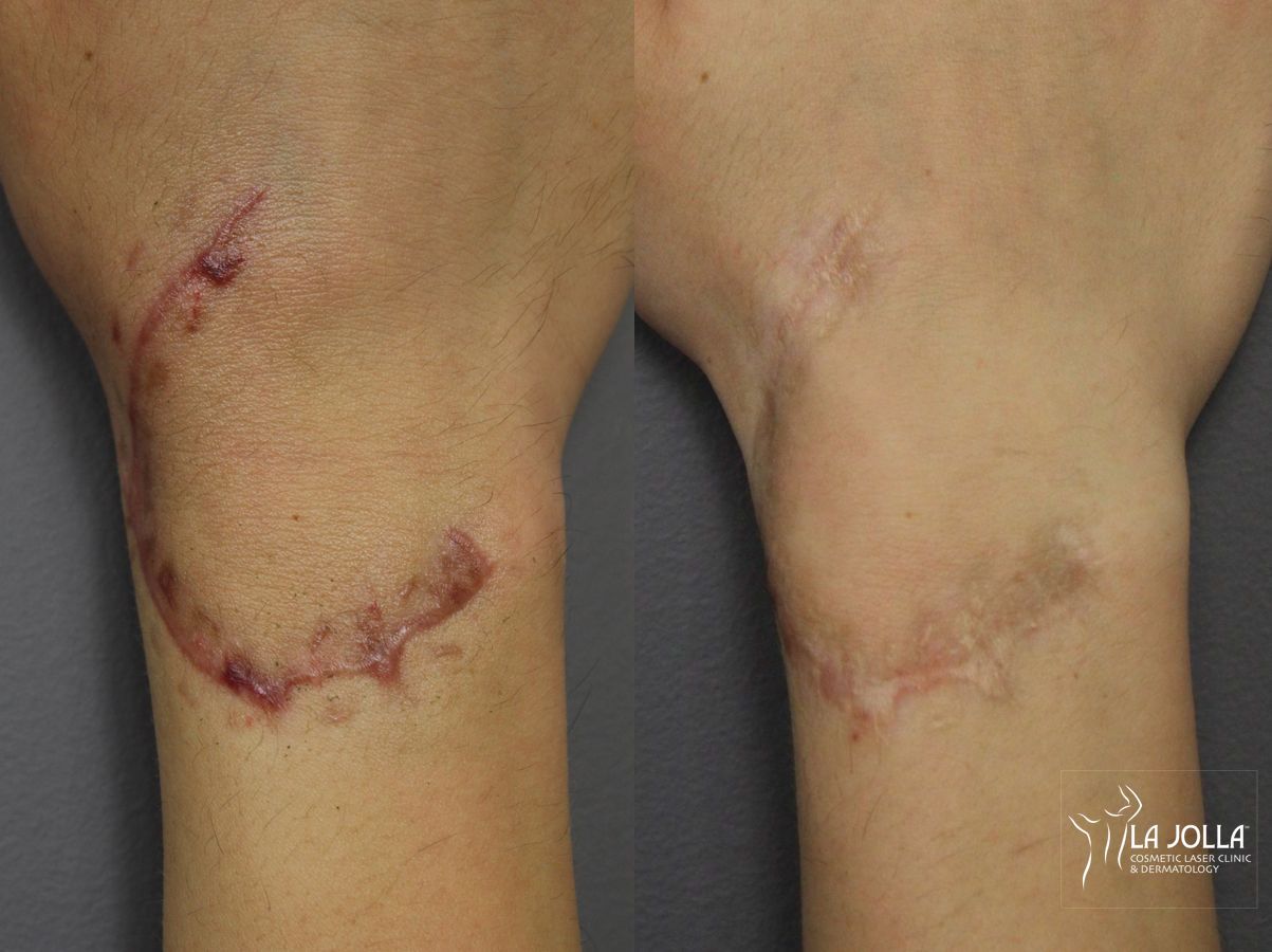 Before and after Scars case 36433