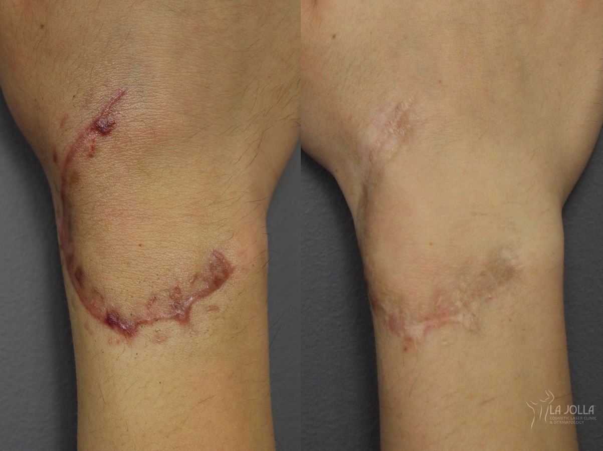 Before and after Scars case 36433