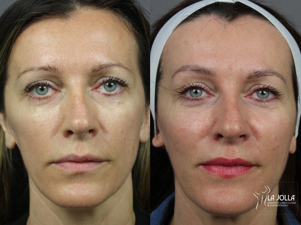 Before and after Sculptra® case 36353