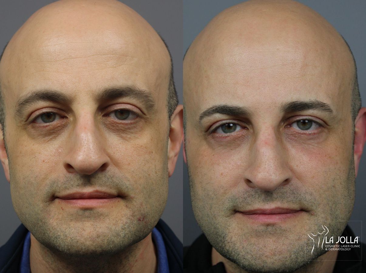 Before and after Sculptra® case 36277