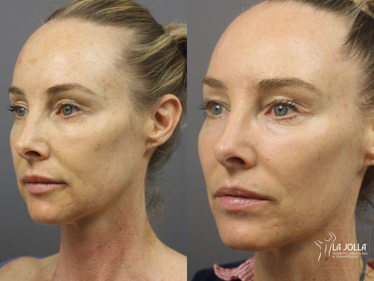 Before and after Sculptra® case 36356