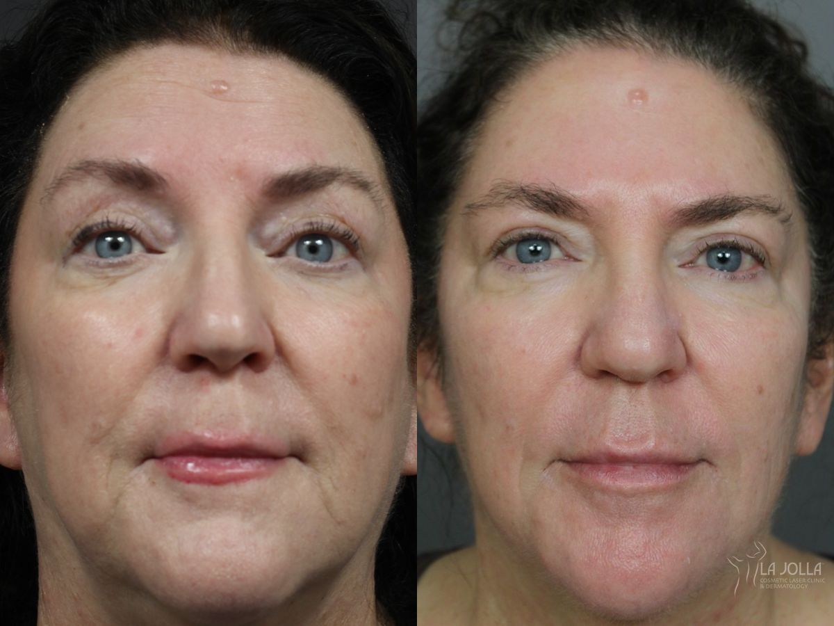 Before and after Sculptra® case 46317