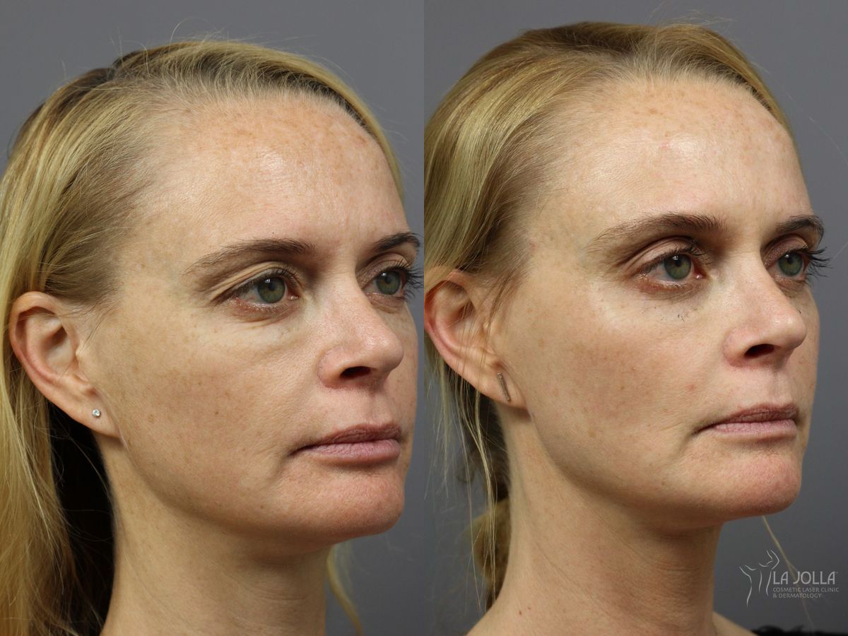 Before and after Sculptra® case 36330