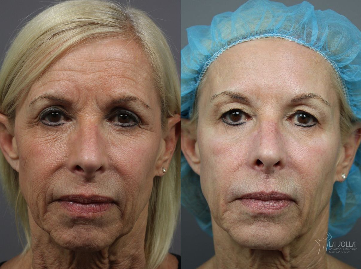 Before and after Sculptra® case 36328