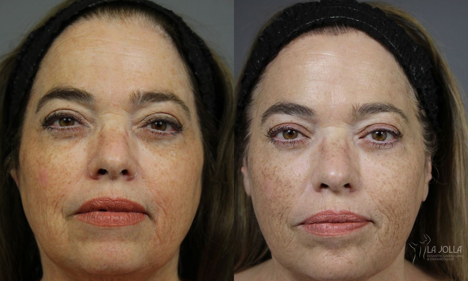Before and after Sculptra® case 36220