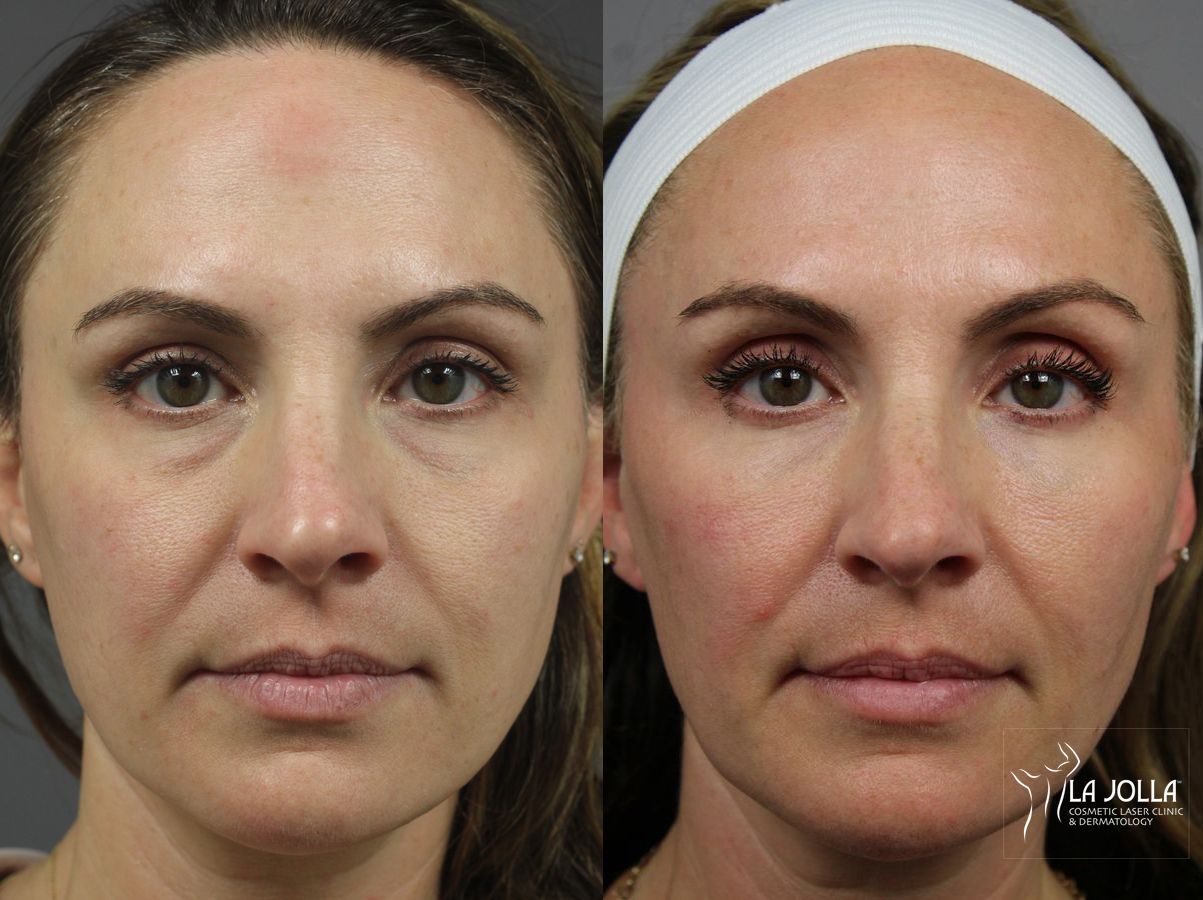 Before and after Sculptra® case 36309
