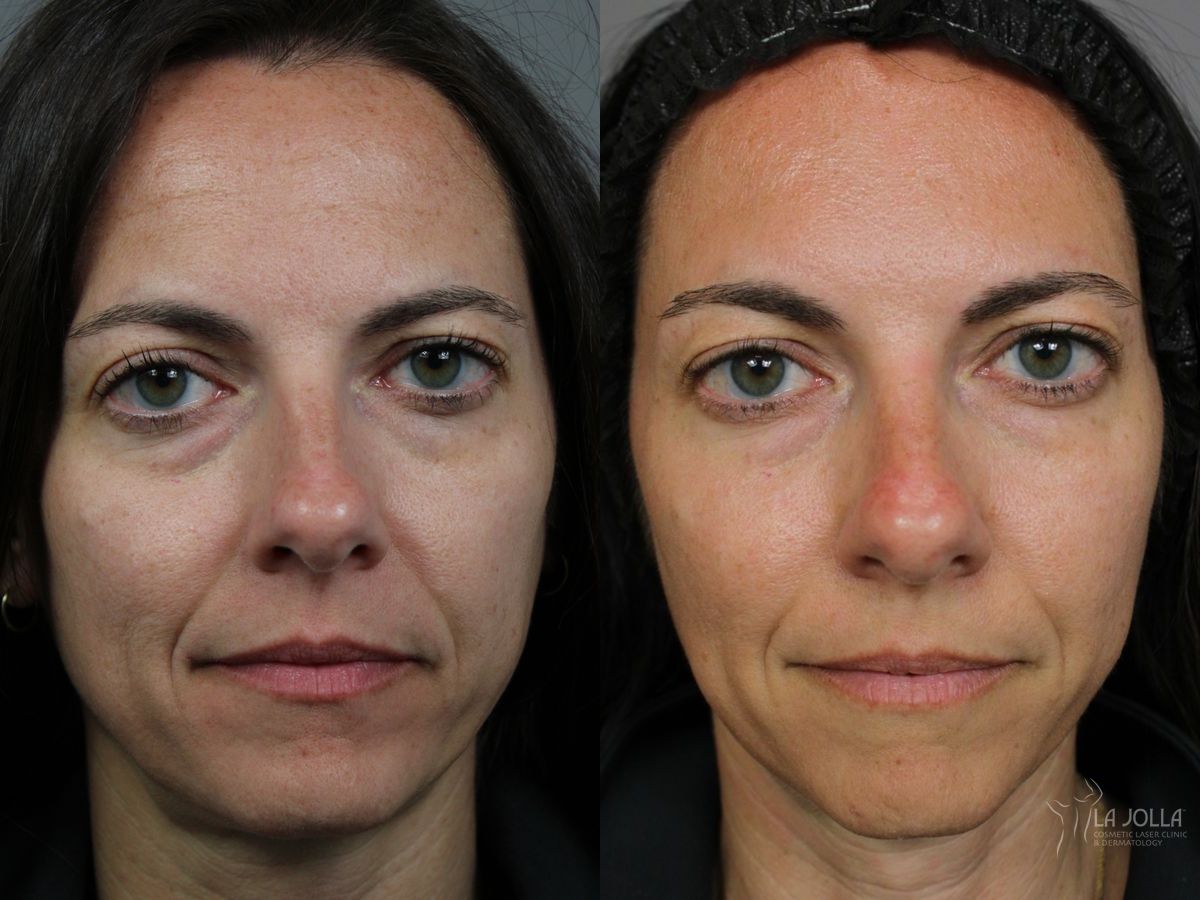 Before and after Sculptra® case 46315