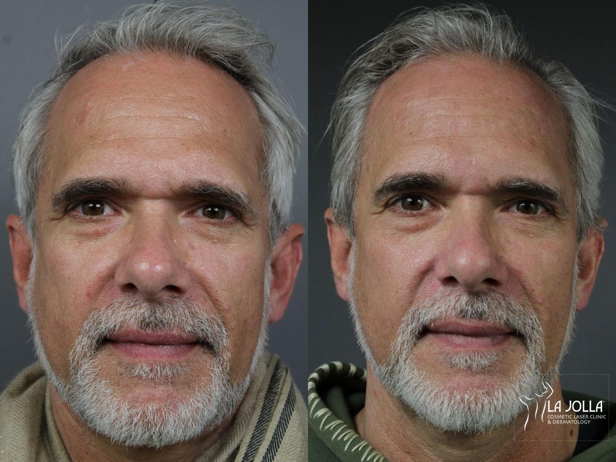Before and after Sculptra® case 36142