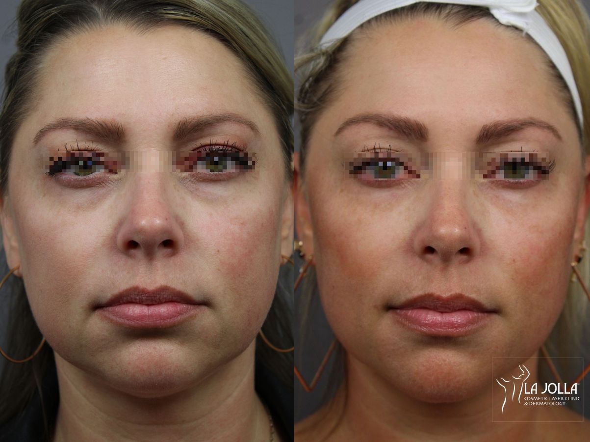 Before and after Sculptra® case 36308