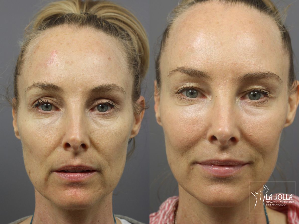 Before and after Sculptra® case 36347