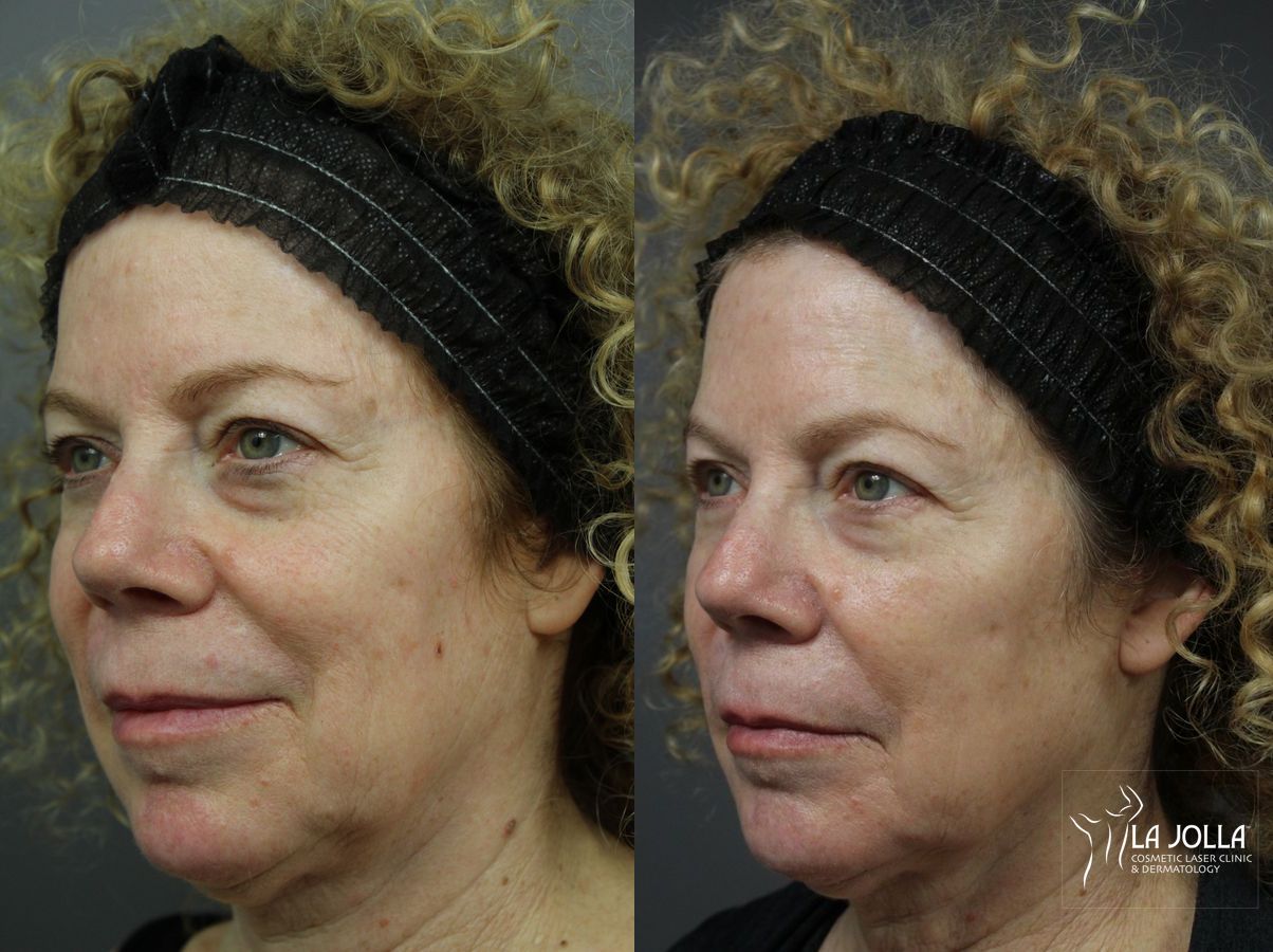 Before and after Sculptra® case 36088