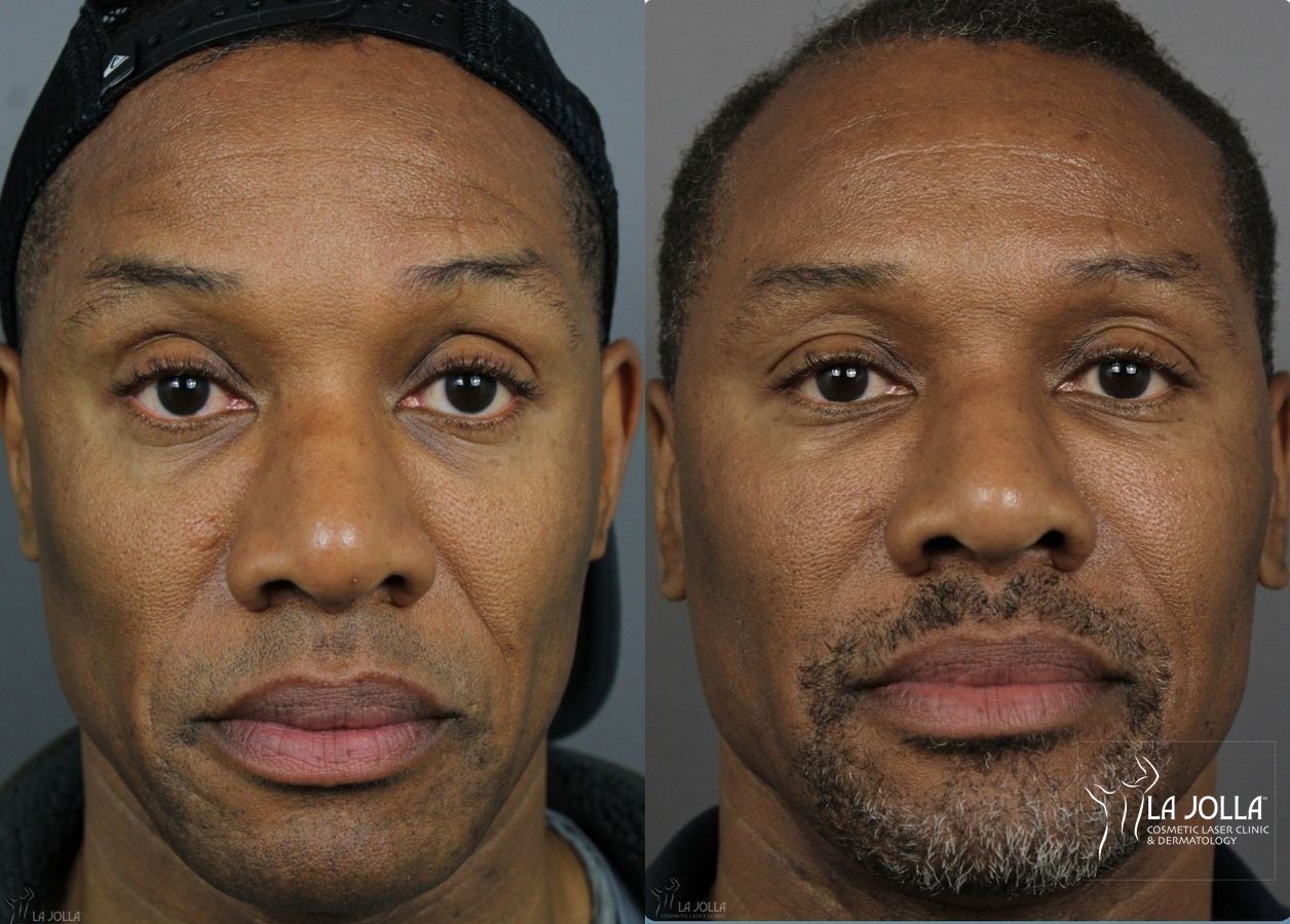 Before and after Sculptra® case 36245