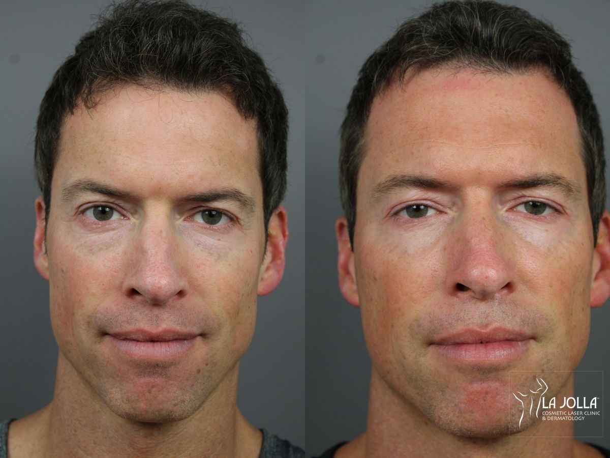 Before and after Sculptra® case 36331