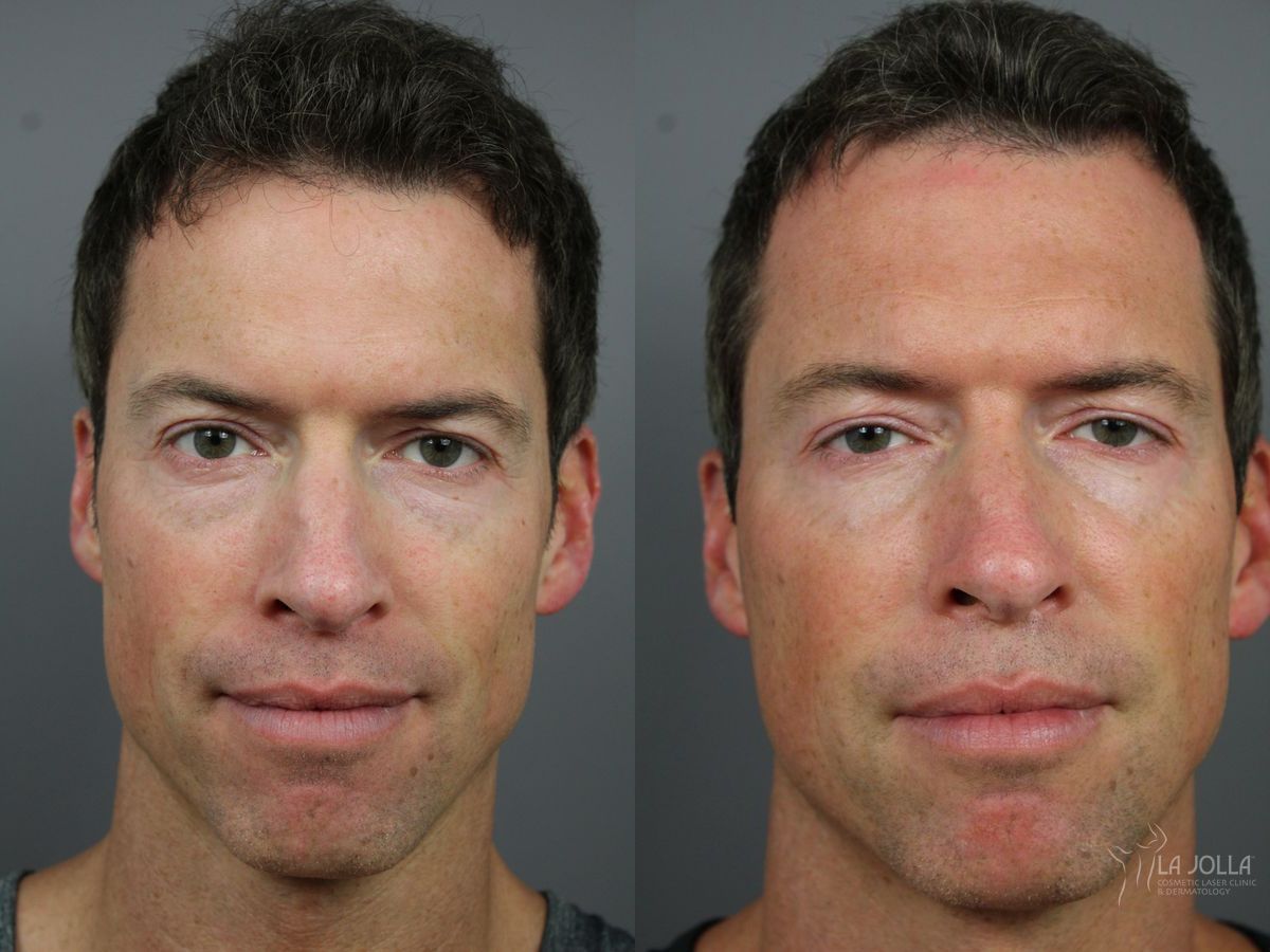 Before and after Sculptra® case 36331