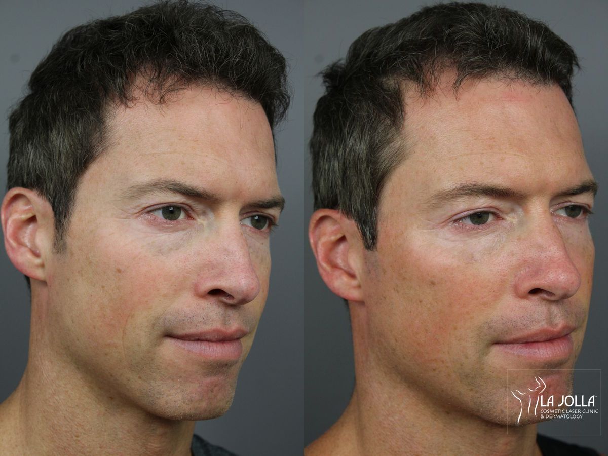 Before and after Sculptra® case 36332