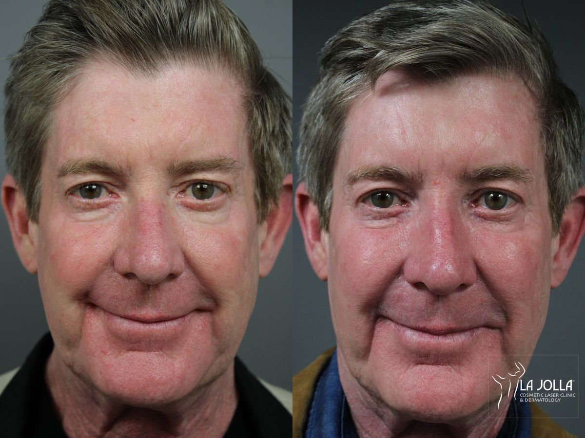 Before and after Sculptra® case 36140