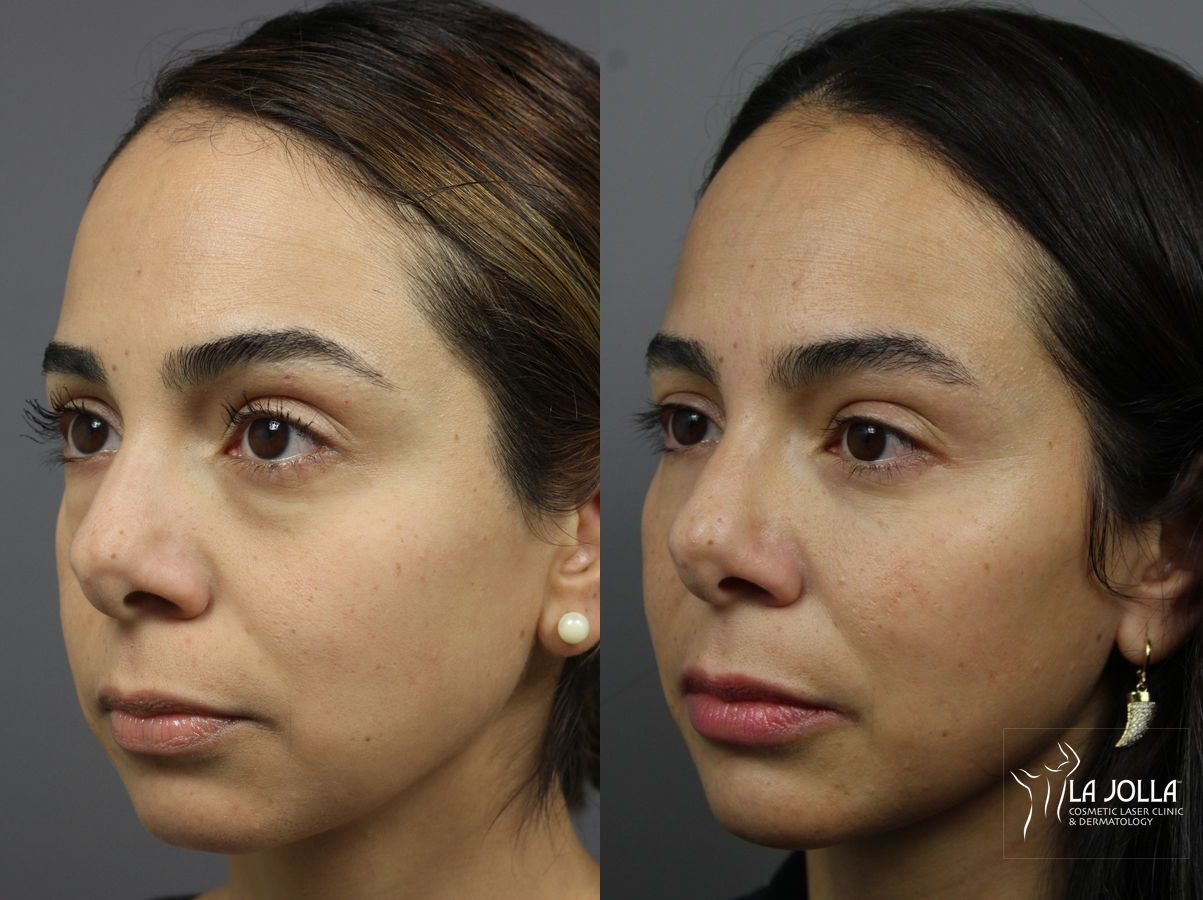 Before and after Sculptra® case 36341 - Angle 2
