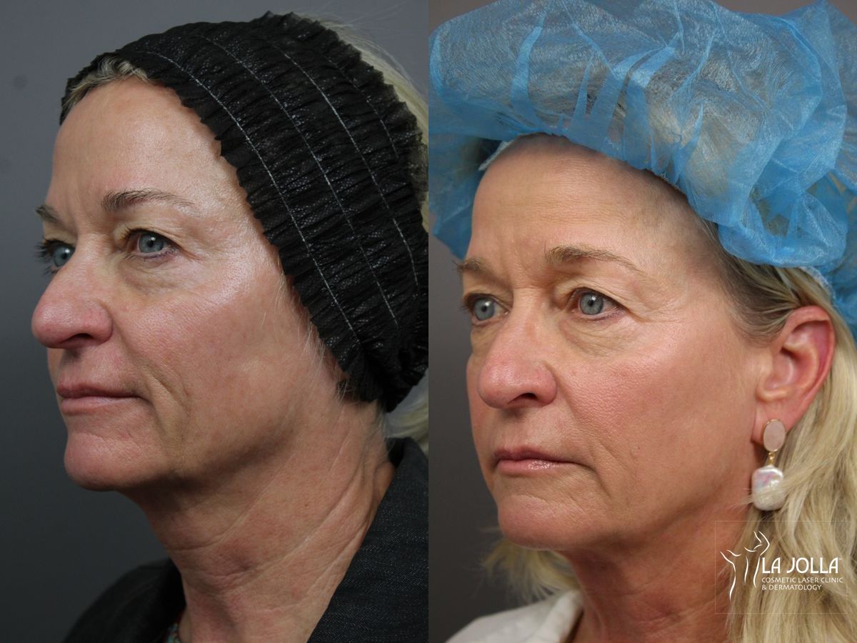 Before and after Sculptra® case 36215 - Angle 2