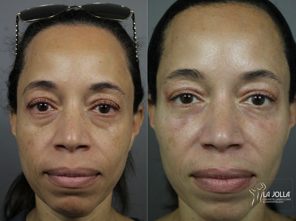 Before and after Sculptra® case 36268