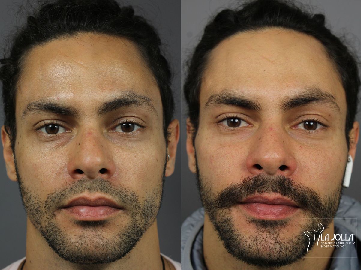 Before and after Sculptra® case 36288