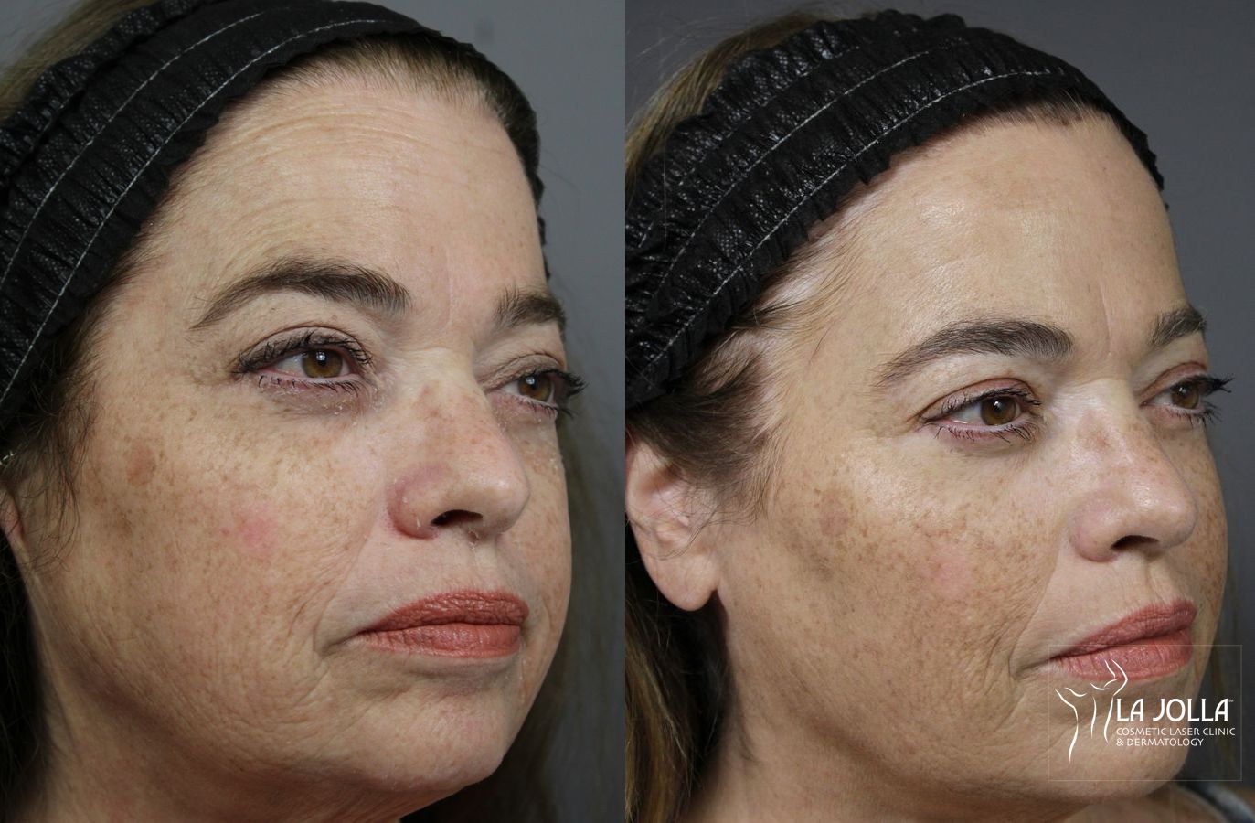 Before and after Sculptra® case 36220 - Angle 3