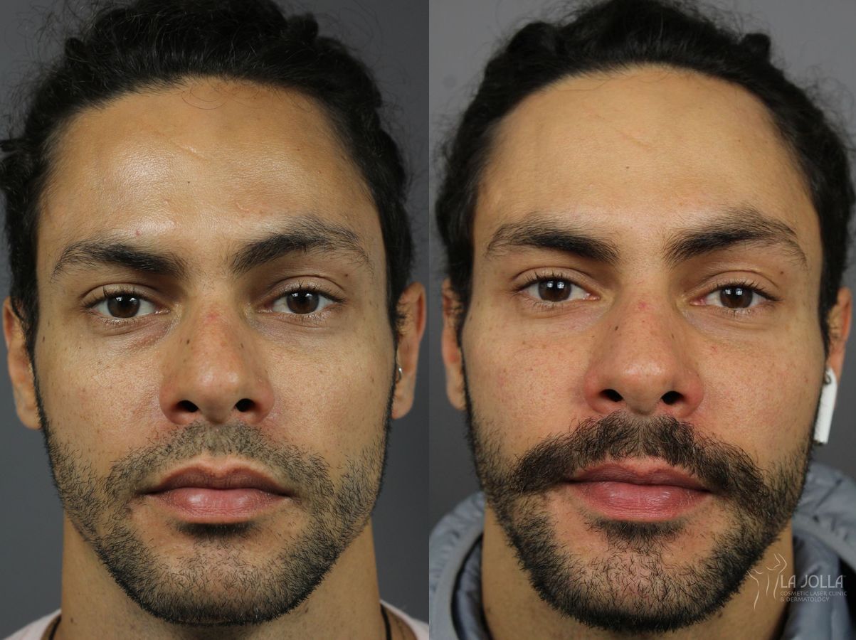 Before and after Sculptra® case 36288