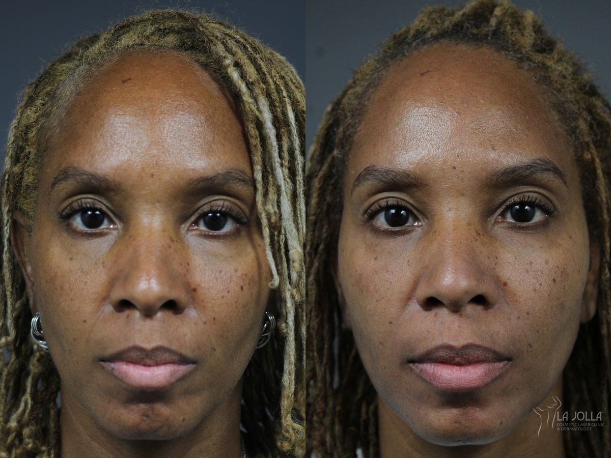 Before and after Sculptra® case 36178