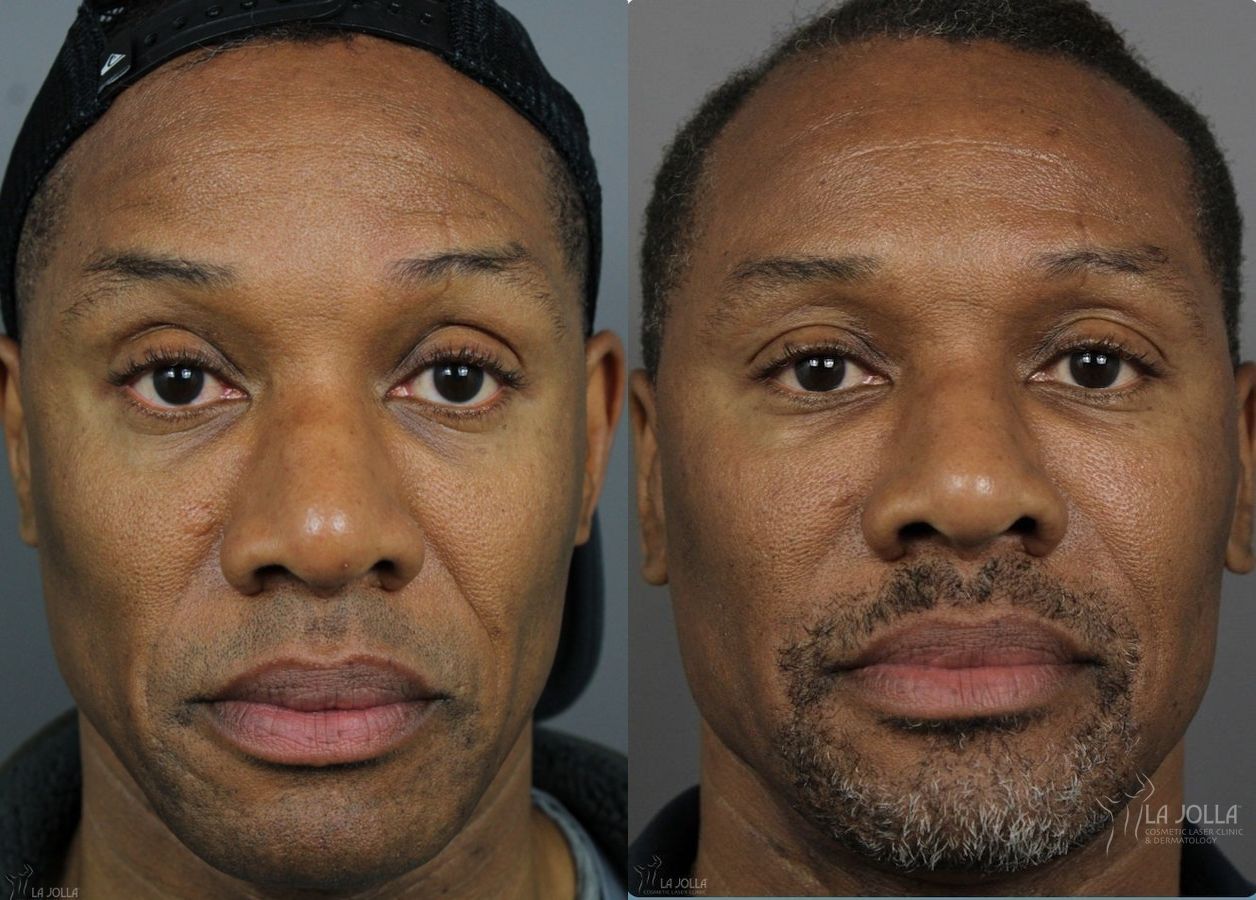 Before and after Sculptra® case 36245