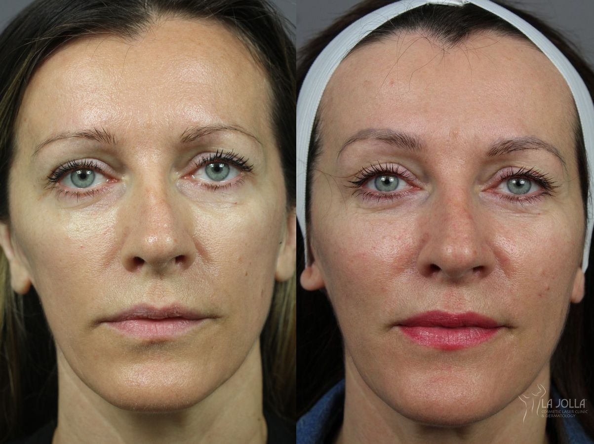 Before and after Sculptra® case 36353