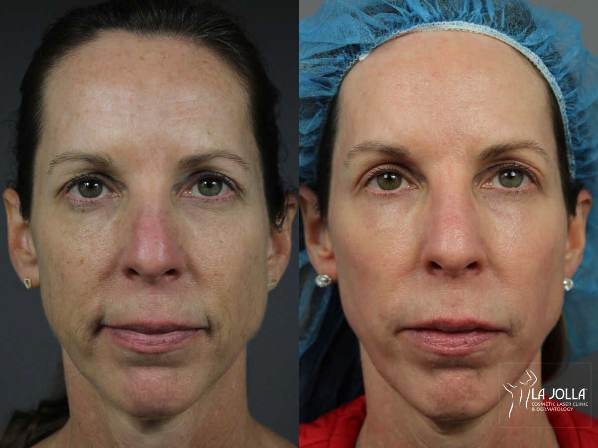 Before and after Sculptra® case 36363