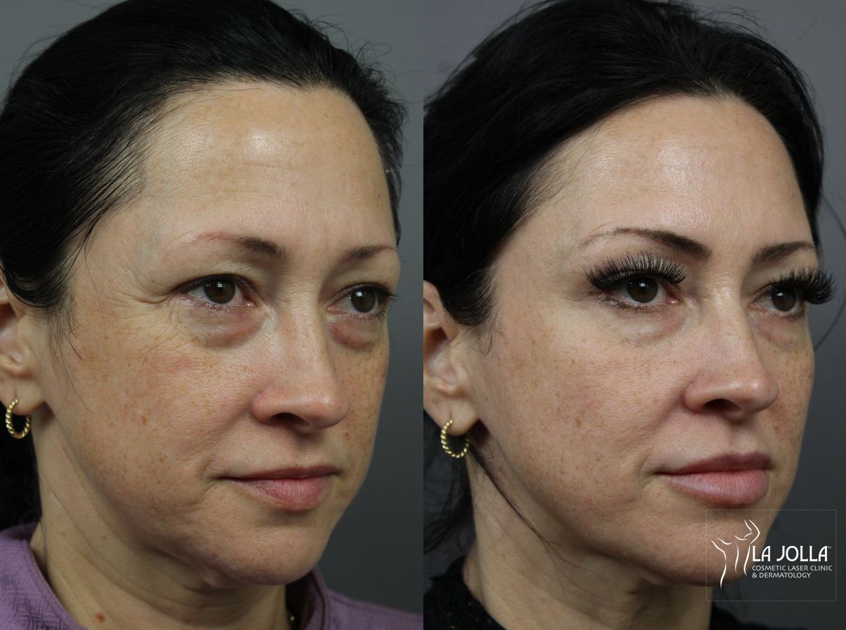 Before and after Sculptra® case 36315