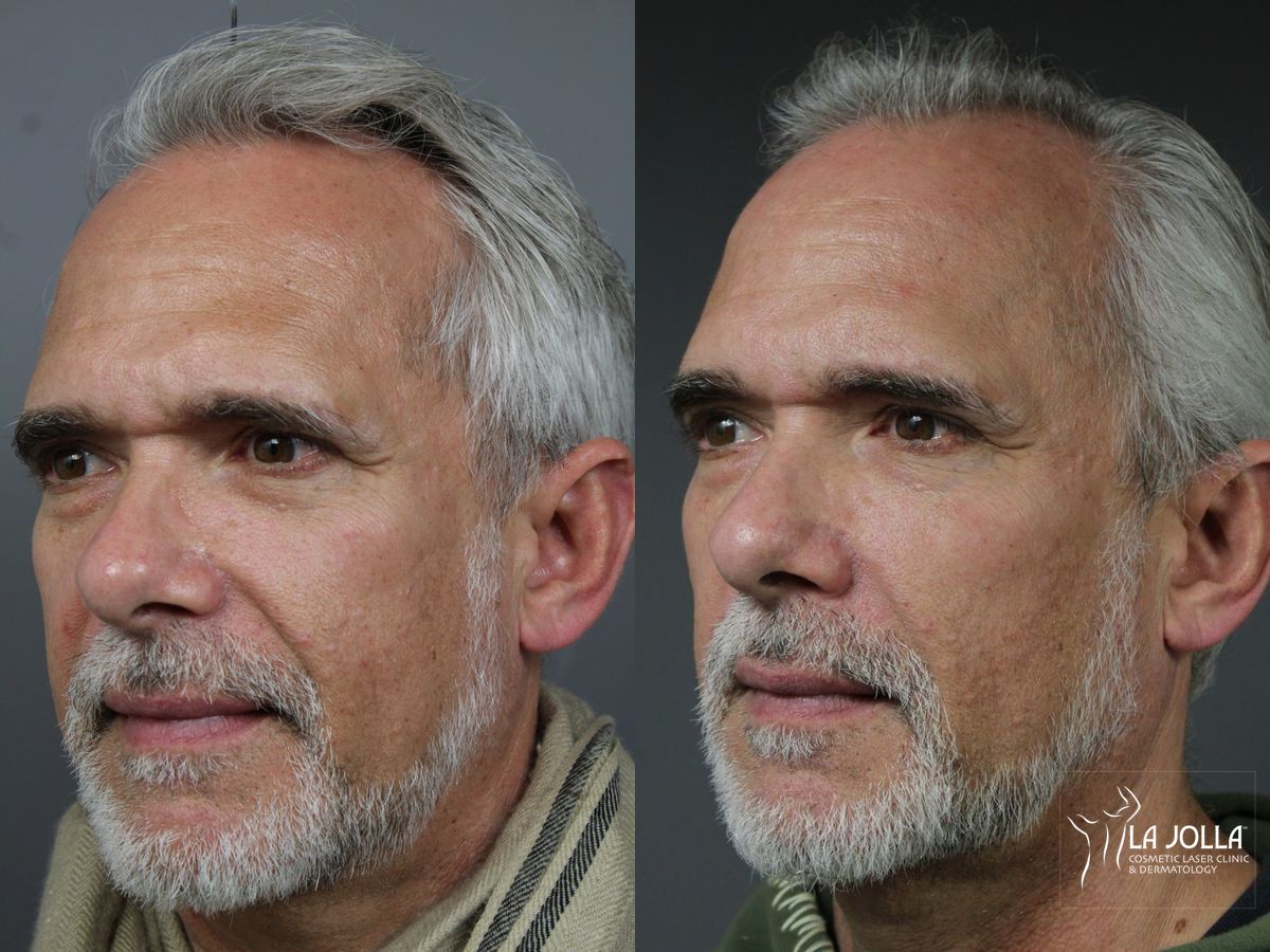 Before and after Sculptra® case 36142 - Angle 2