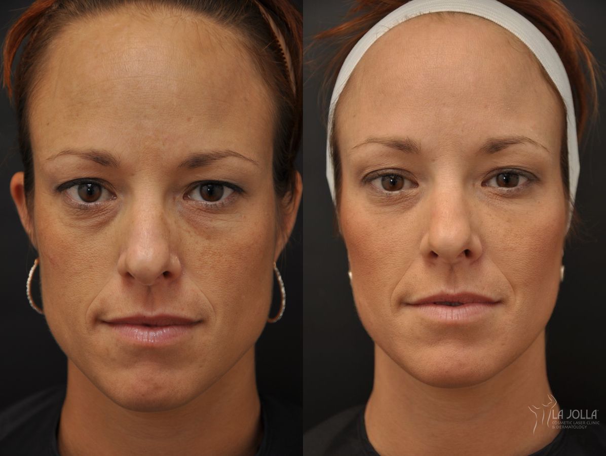 Before and after Sculptra® case 36346