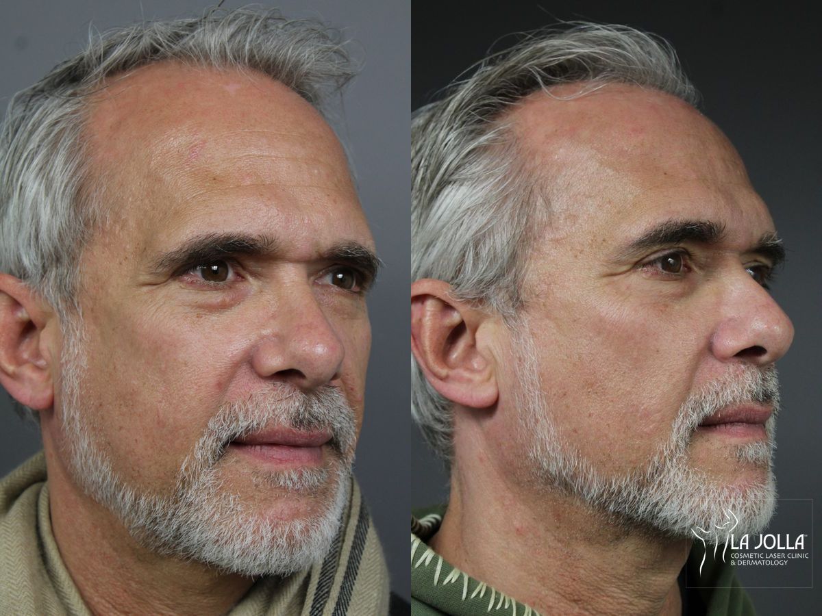 Before and after Sculptra® case 36142 - Angle 3