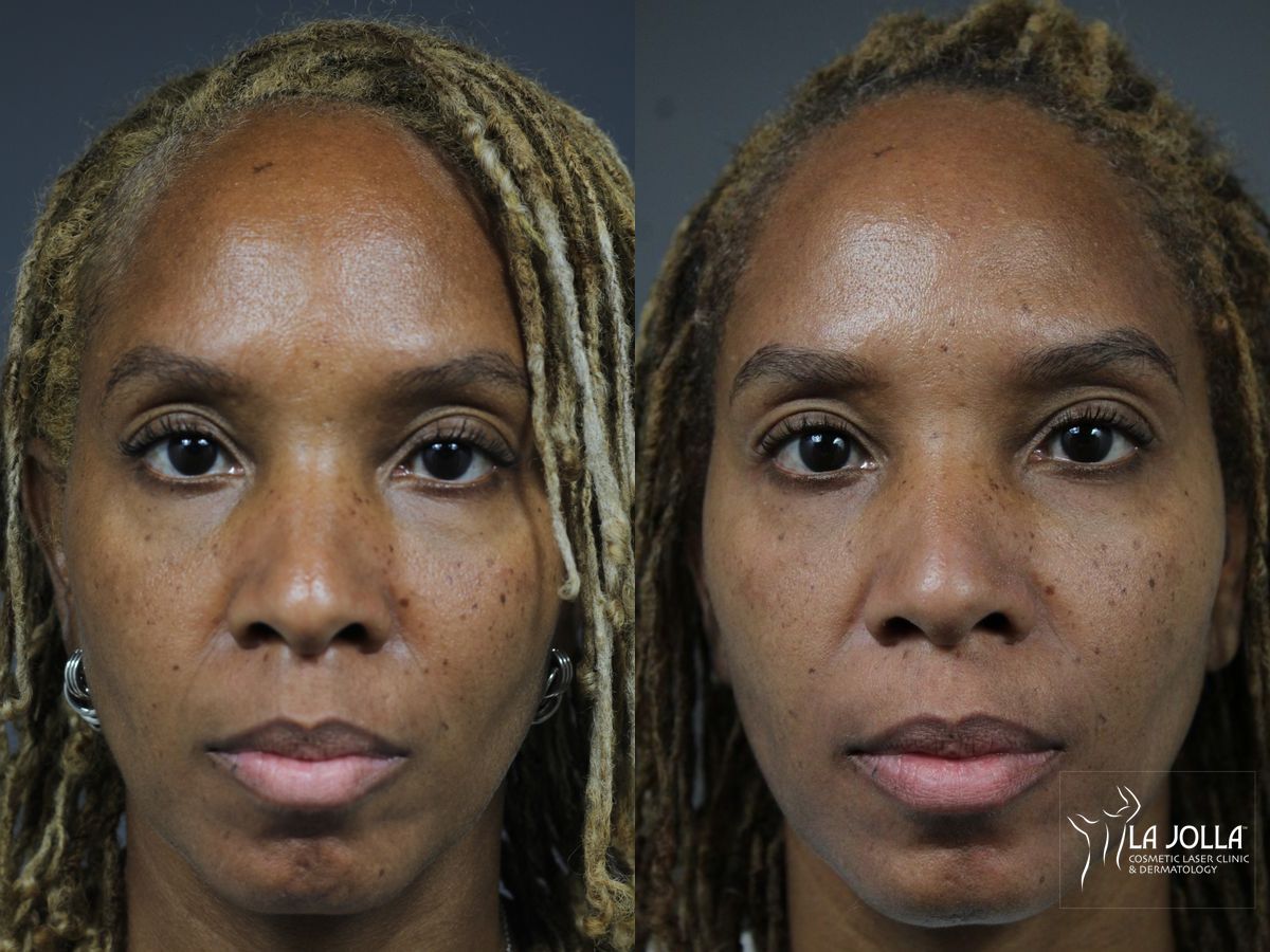 Before and after Sculptra® case 36178