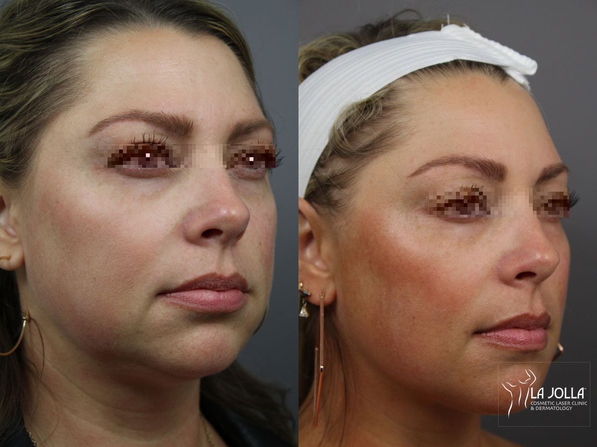 Before and after Sculptra® case 36339