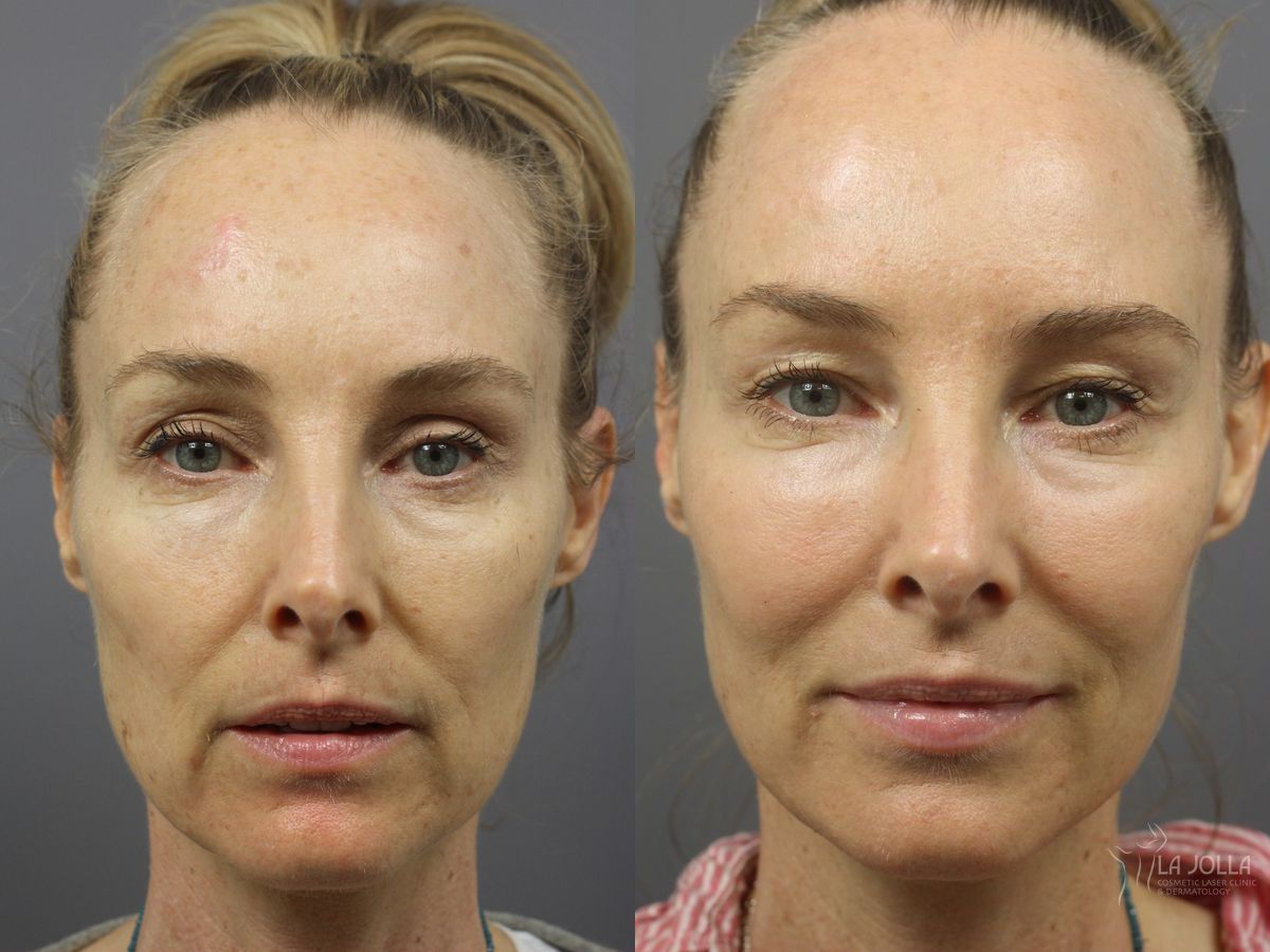 Before and after Sculptra® case 36347