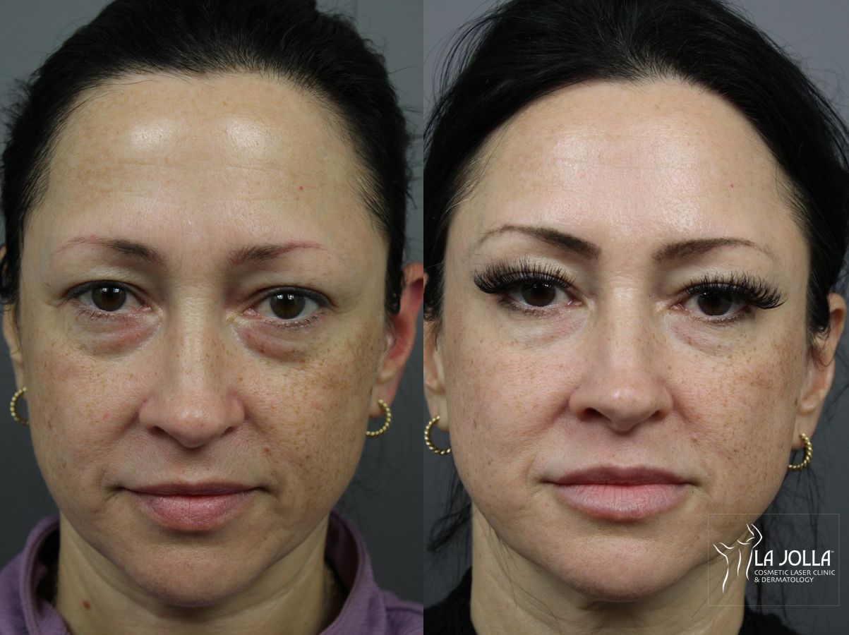 Before and after Sculptra® case 36315 - Angle 2