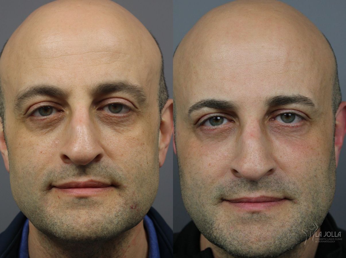 Before and after Sculptra® case 36277
