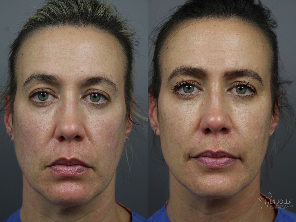 Before and after Sculptra® case 36334