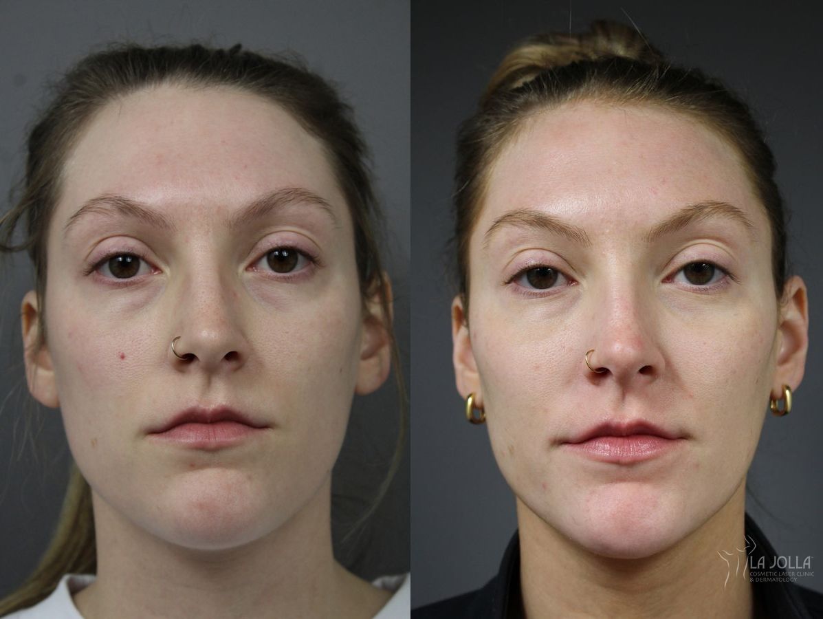 Before and after Sculptra® case 36282