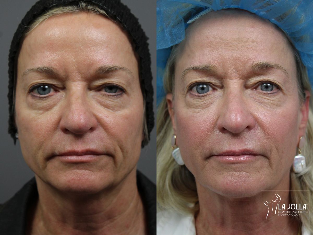 Before and after Sculptra® case 36215
