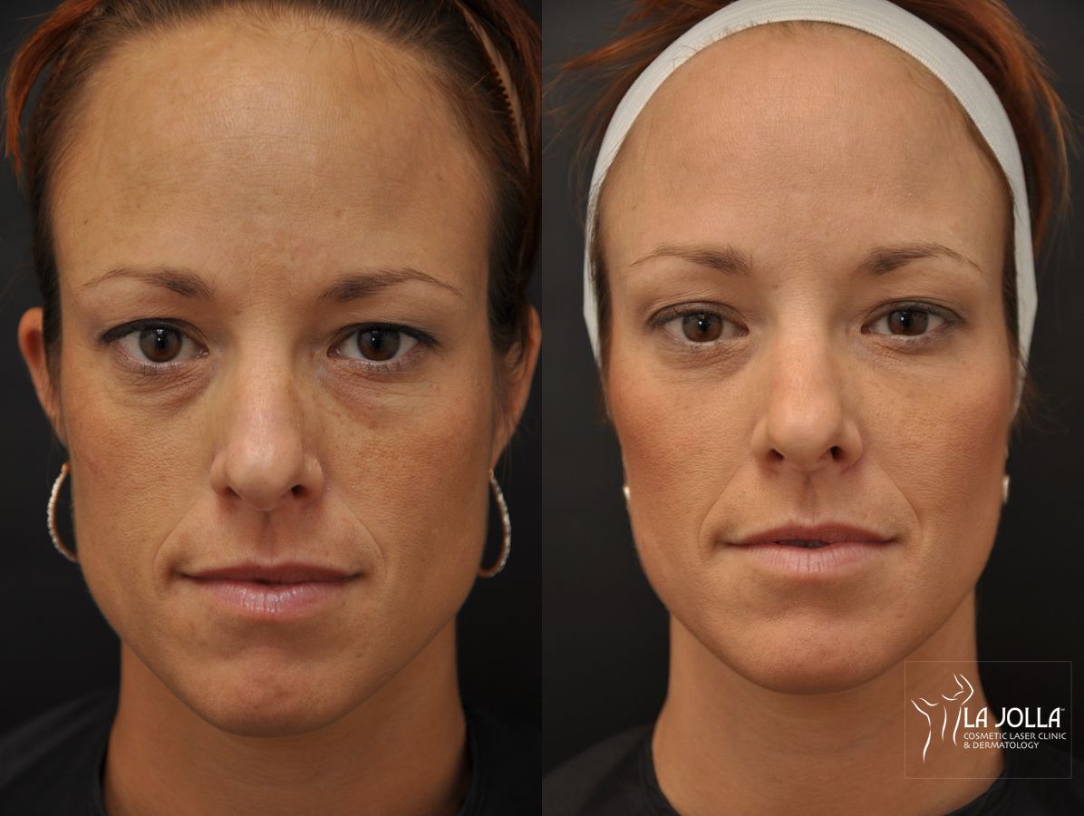 Before and after Sculptra® case 36346