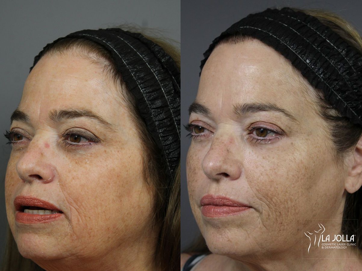 Before and after Sculptra® case 36220 - Angle 2