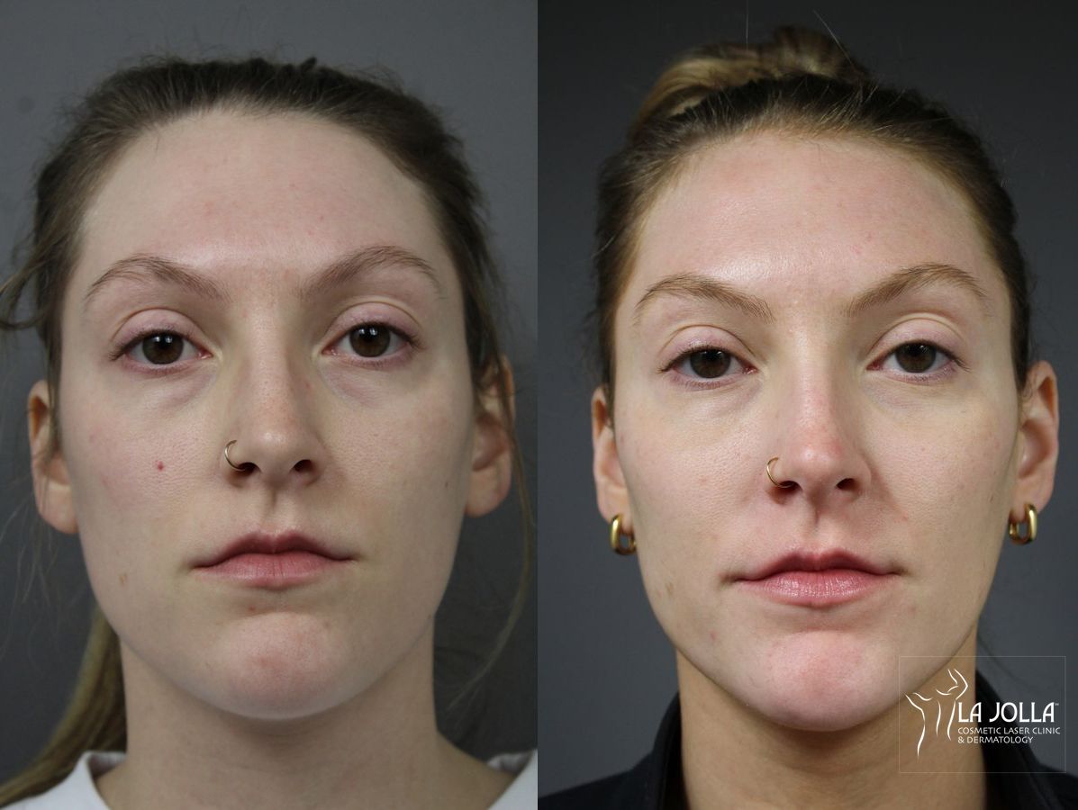 Before and after Sculptra® case 36282
