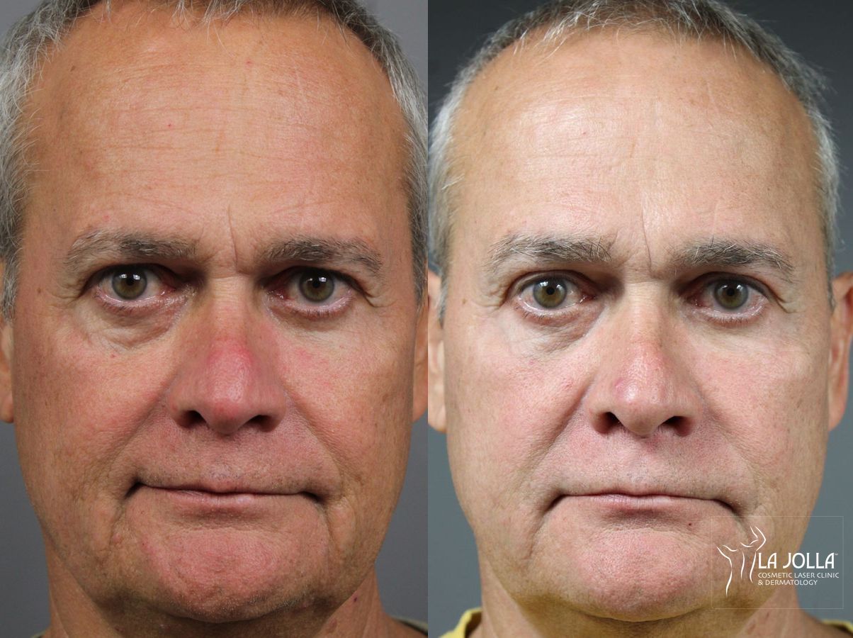 Before and after Sculptra® case 36264