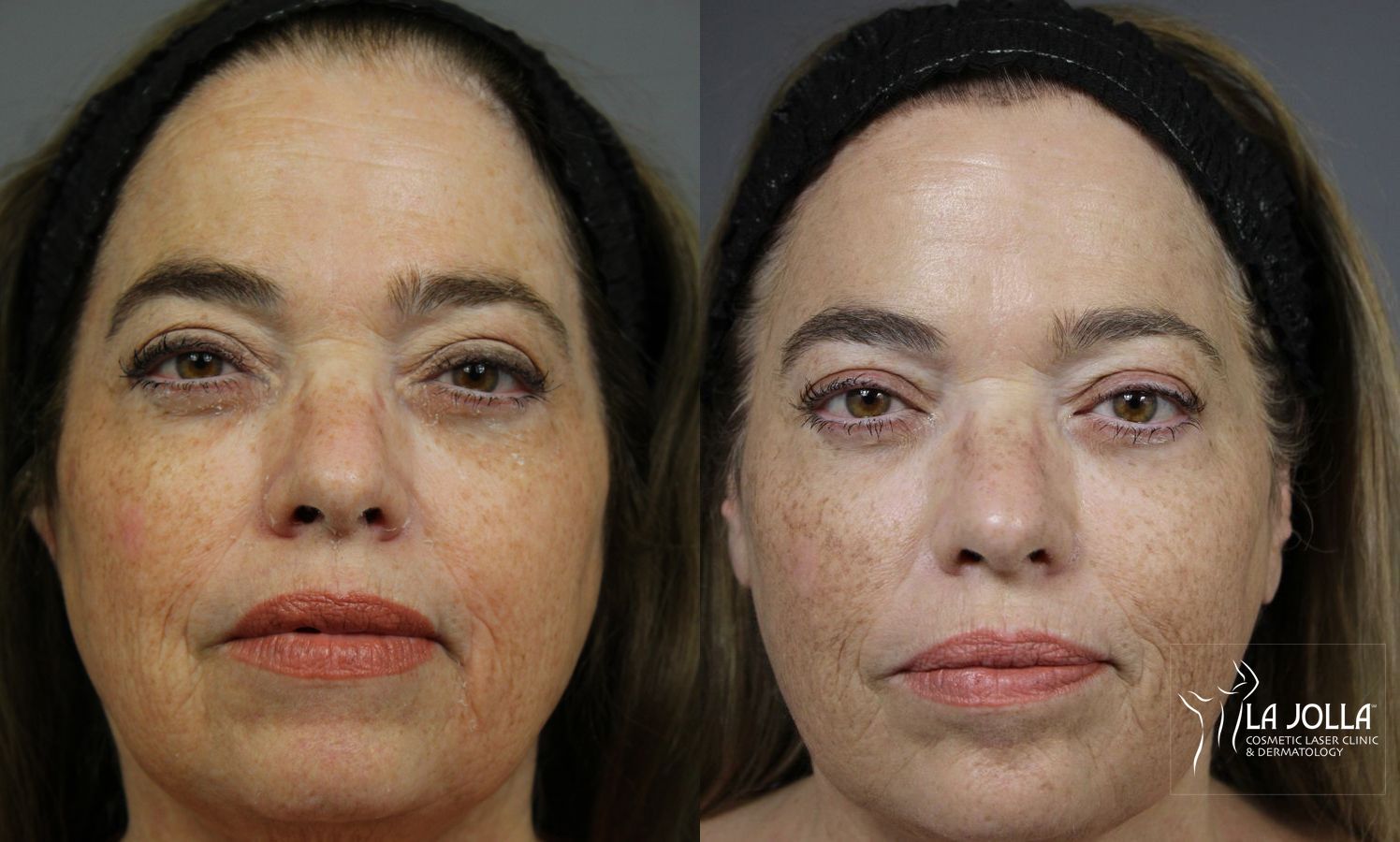 Before and after Sculptra® case 36220