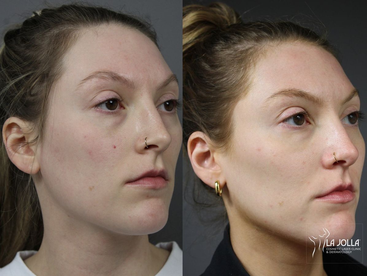 Before and after Sculptra® case 36282 - Angle 2