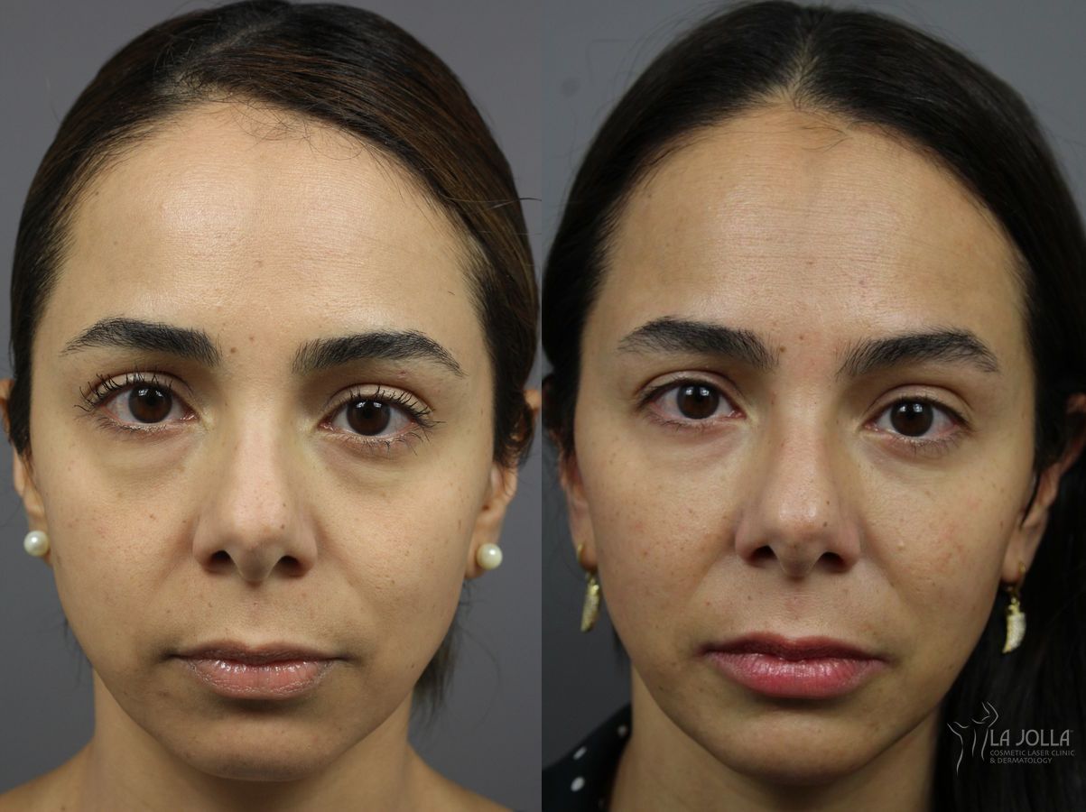 Before and after Sculptra® case 36341